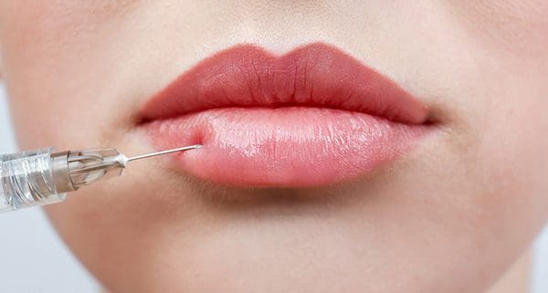 Dermal Lip Fillers: How Long They Last and When to Come Back
